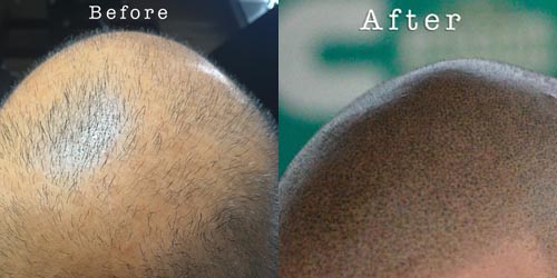scalp micropigmentation delhi india